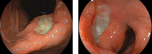 左：胃潰瘍（胃角小弯）の内視鏡像 右：十二指腸潰瘍（球部前壁）の内視鏡像
