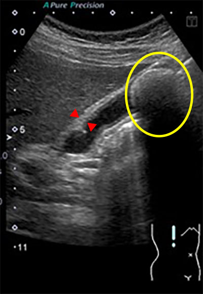 胆石、胆嚢炎の腹部超音波画像