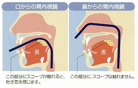 内視鏡検査の口からと経鼻からの比較図