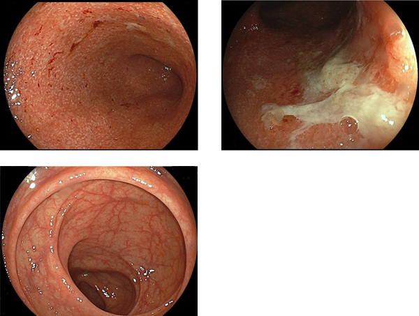毛細血管透見性消失及び易出血性（左上）、潰瘍形成（右上）、正常粘膜（下段）