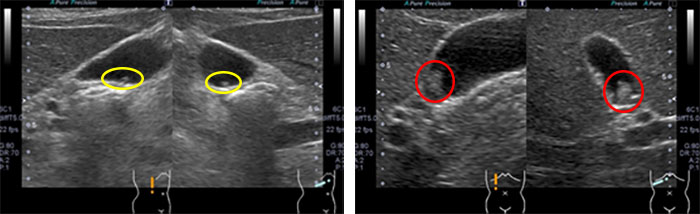 胆嚢ポリープの腹部超音波画像