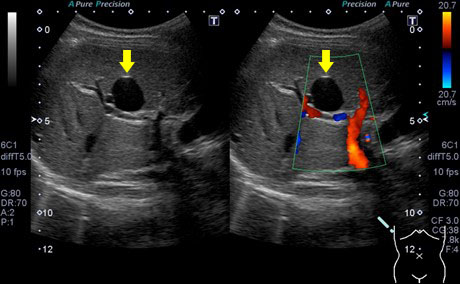 肝嚢胞の超音波画像：黄矢印
