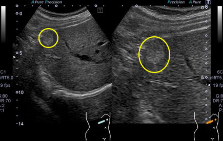肝血管腫の腹部超音波画像