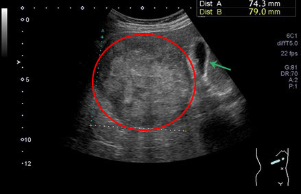 肝細胞癌の腹部超音波画像