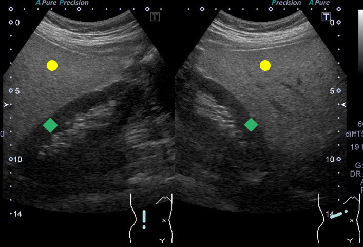 脂肪肝の腹部超音波画像