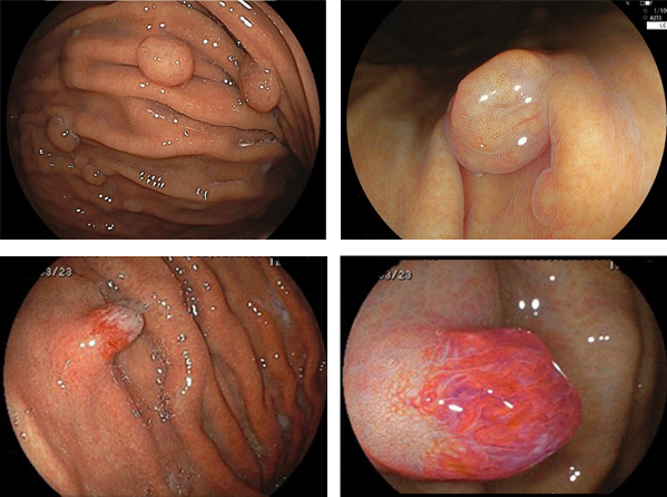左上：多発する胃底腺ポリープ　右上：画像強調拡大像