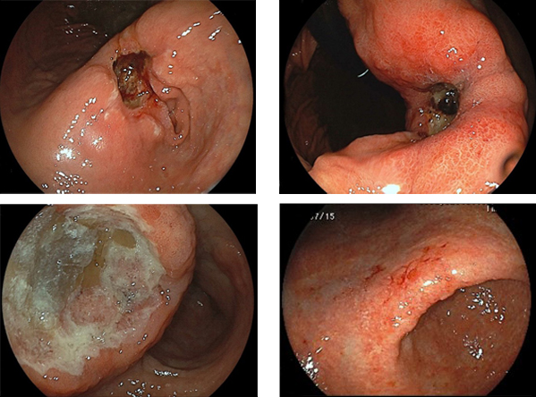 左上：多発する胃底腺ポリープ　右上：画像強調拡大像